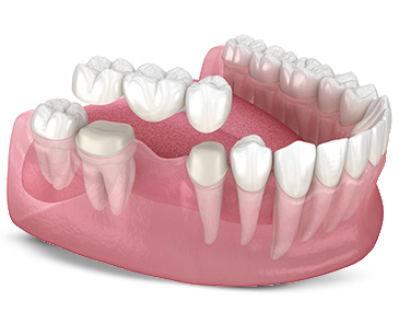 Dental Crowns & Bridge