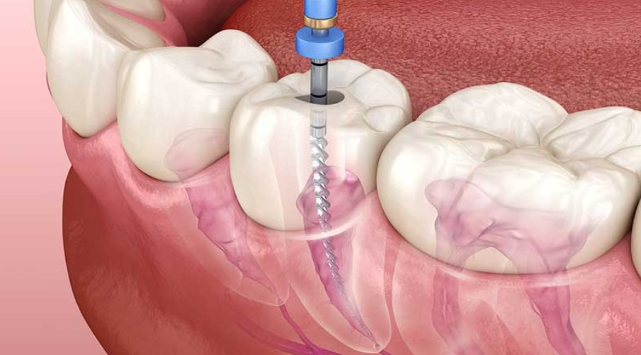 Root Canal Treatment