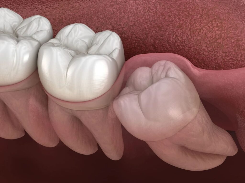 wisdom tooth dental