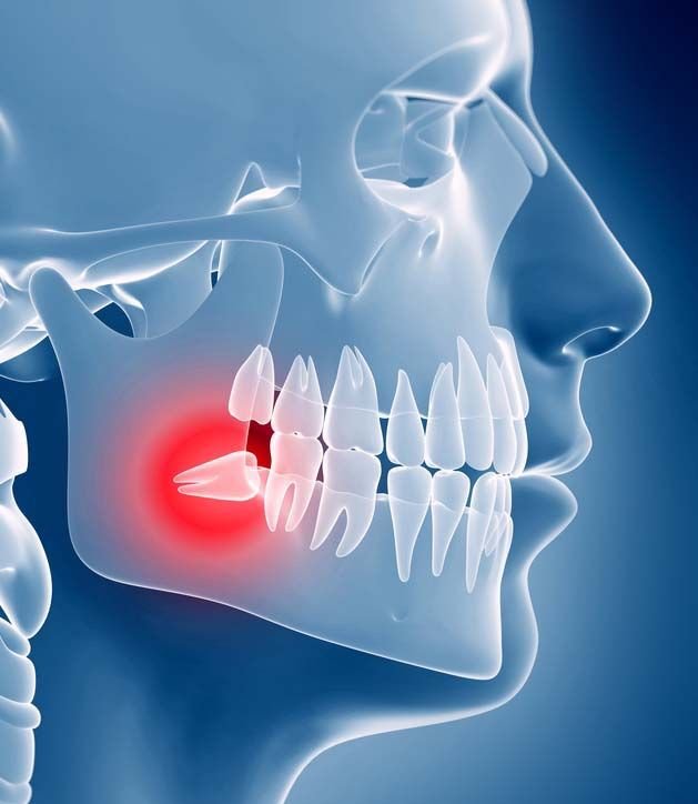 wisdom teeth