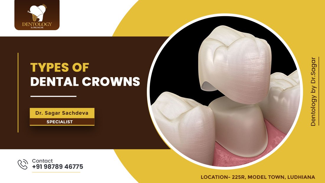 Types of Dental Crowns