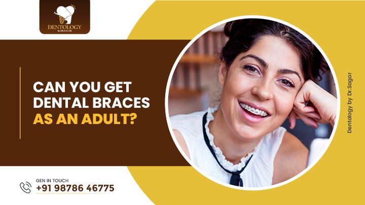 Can You Get Dental Braces as an Adult