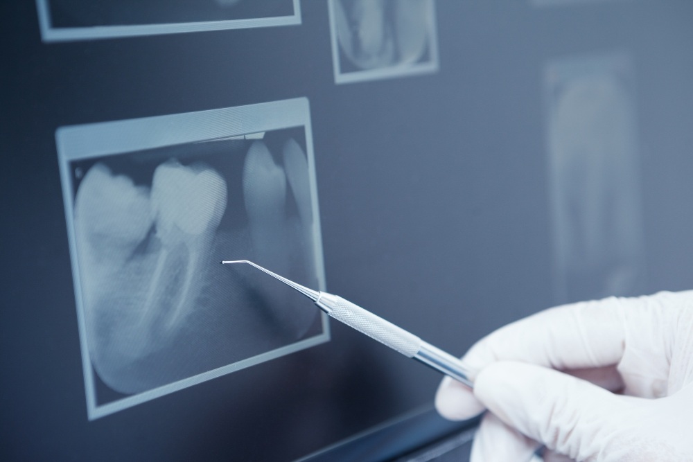Why X-Rays Are Essential in Dentistry