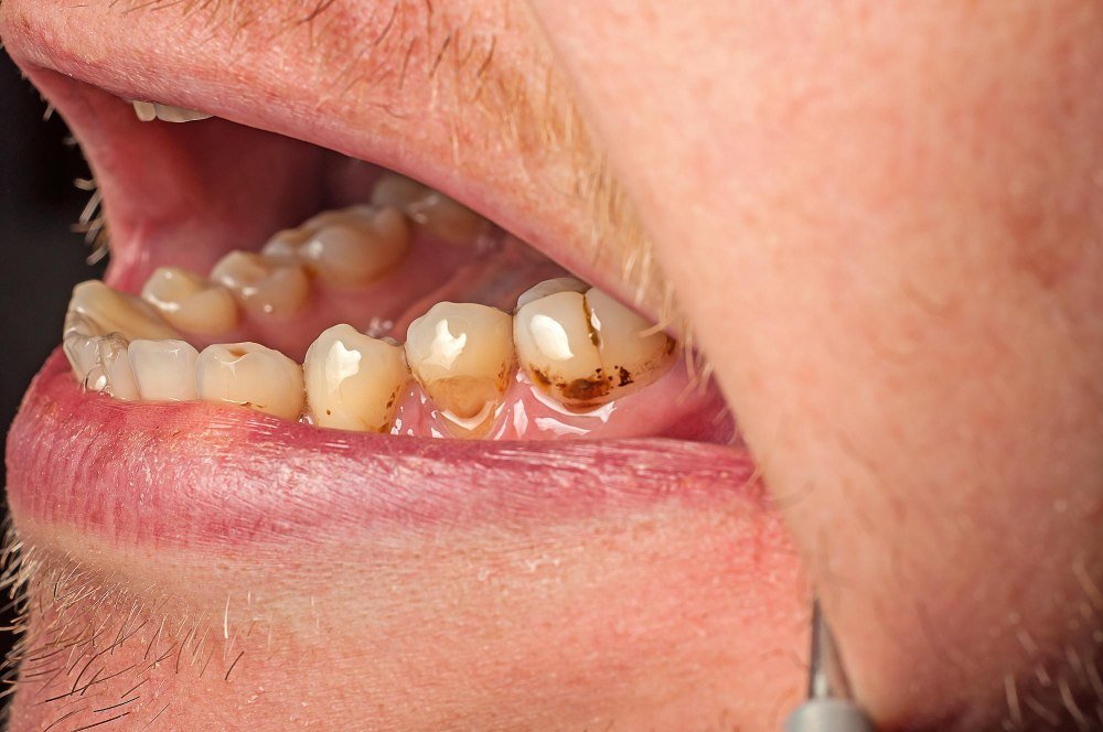 Enamel Damage and Tooth Discoloration
