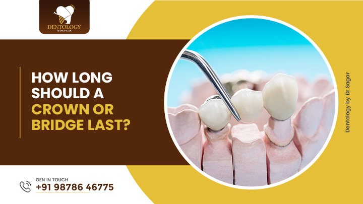 How Long Should a Crown or Bridge Last