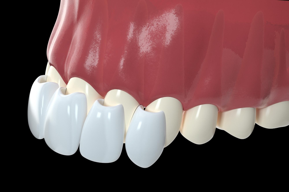 What Are Veneers