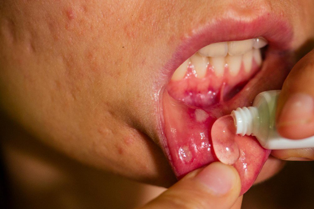 How to Treat and Prevent Mouth Ulcers