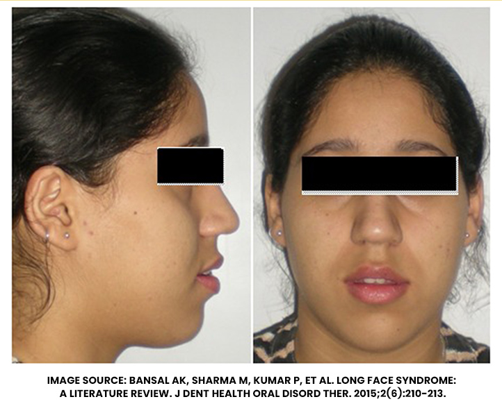 Changes in Facial Structure