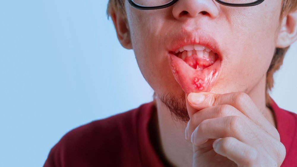 When Mouth Ulcers Indicate a Bigger Health Problem
