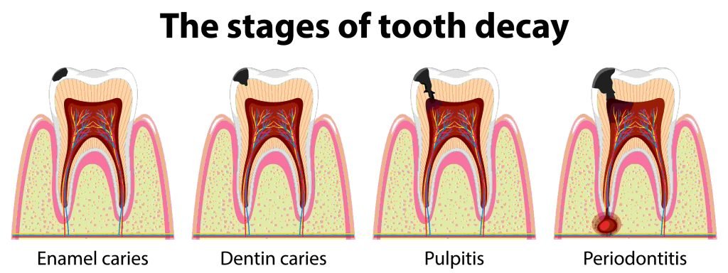 Early Tooth Decay