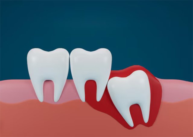 Impacted or Misaligned Teeth