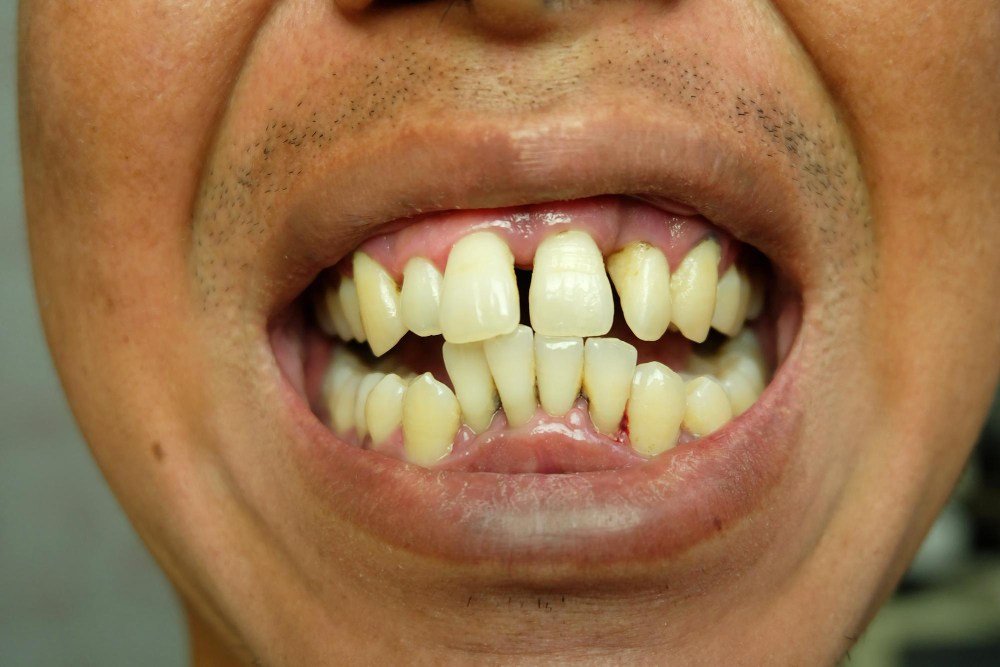 Small Dental Issues Can Turn Into Major Problems