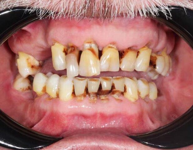 Worn Enamel from Grinding