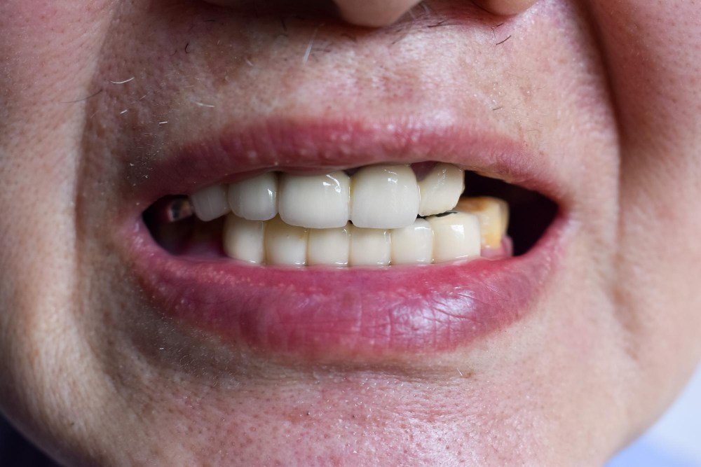 Teeth Grinding and Bite Pressure