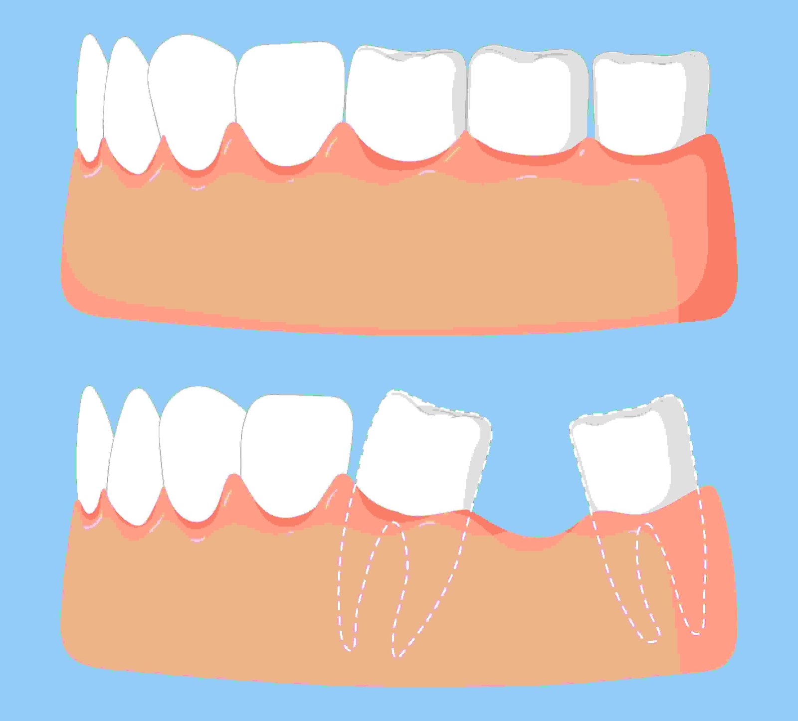 What Happens to Your Teeth When a Tooth Is Missing