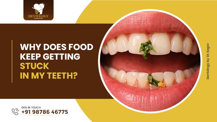 Why Does Food Keep Getting Stuck in My Teeth