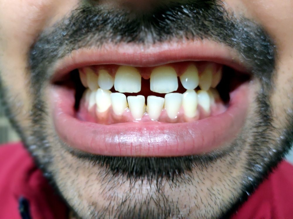 Common Reasons Food Gets Stuck Between Teeth