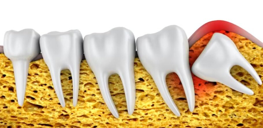 A tooth may need extraction if