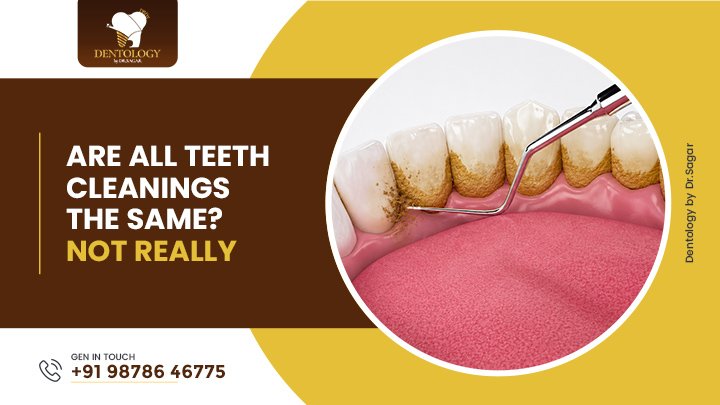 Are All Teeth Cleanings the Same? Not Really