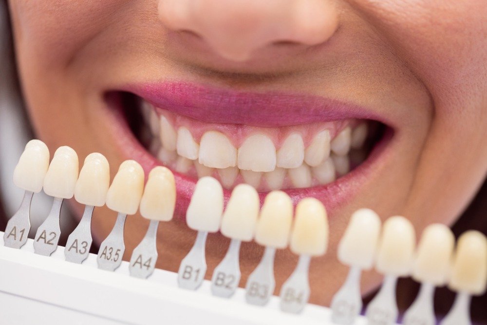 Professional Treatments for Yellow Teeth