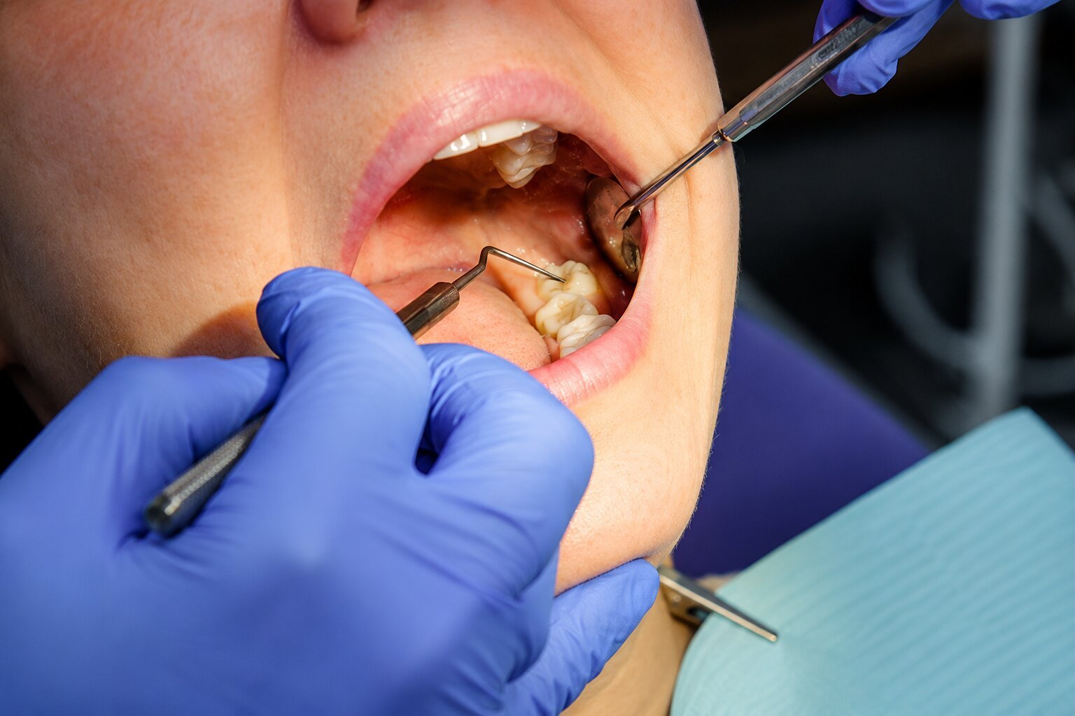 Common Reasons Dentists Monitor a Tooth