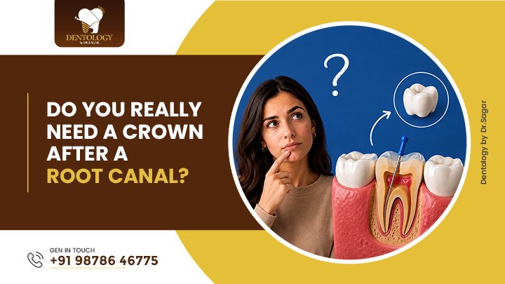 Do You Really Need a Crown After a Root Canal?