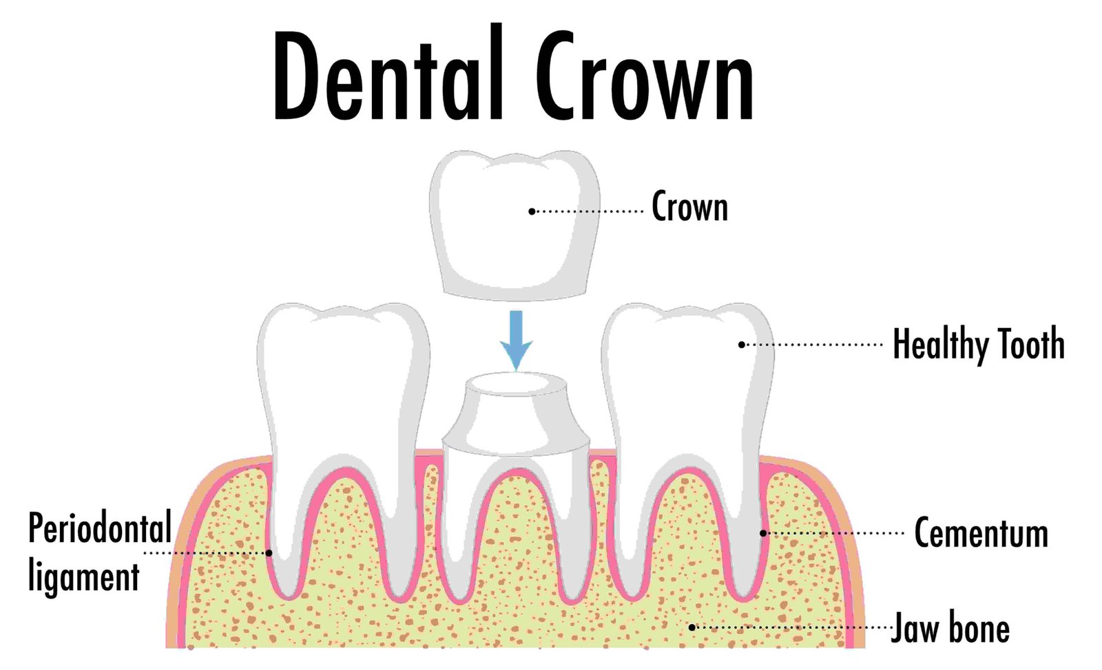What Happens If You Skip the Crown