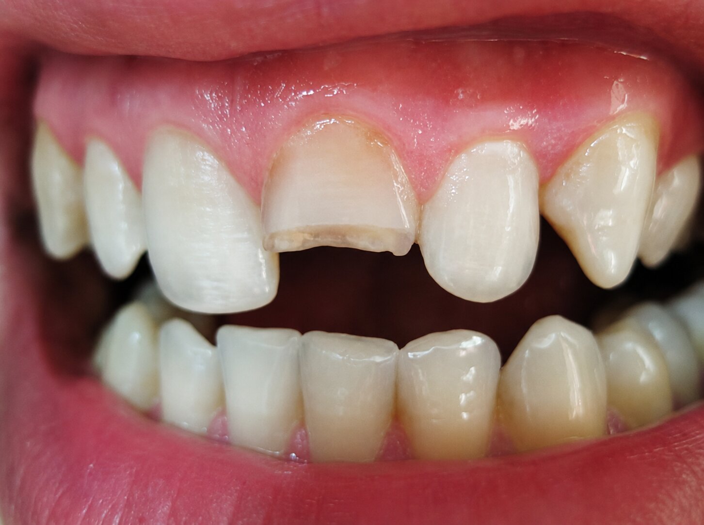 What Causes a Tooth to Lose Too Much Structure