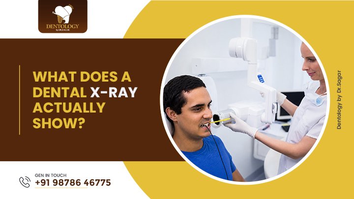 What Does a Dental X-Ray Actually Show?