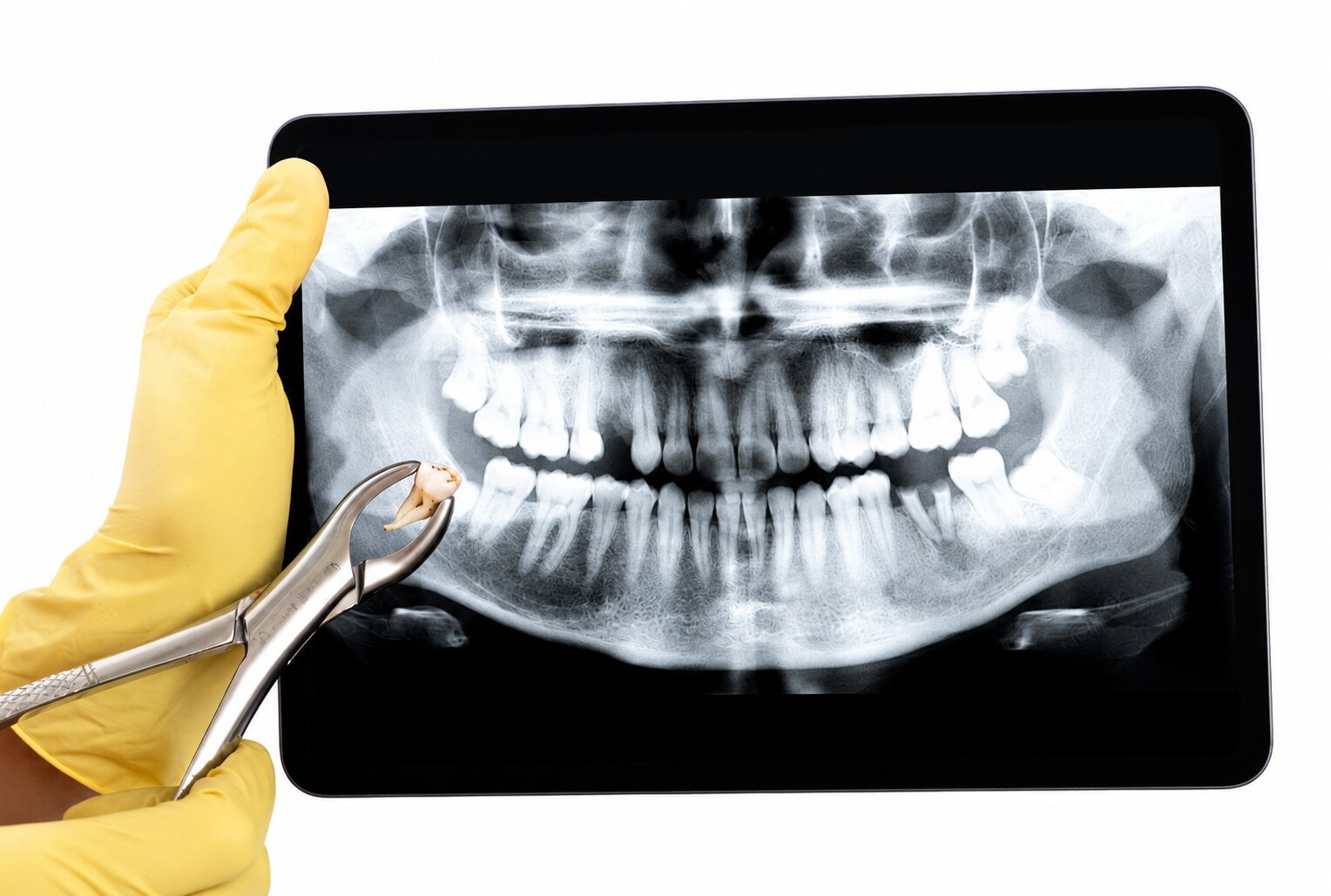 What Does a Panoramic Dental X-Ray Show