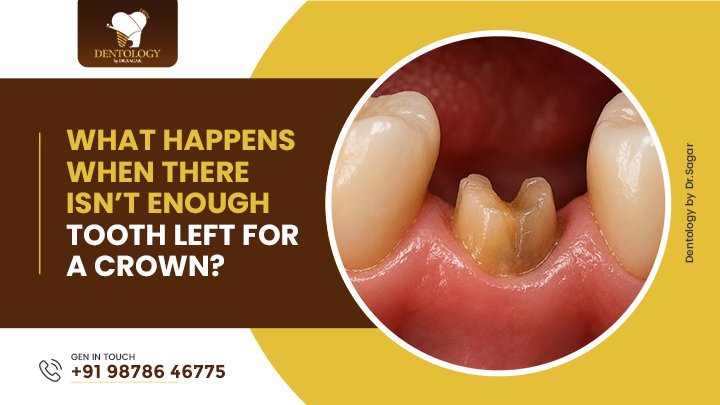 Not enough tooth left for a crown