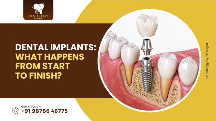 Dental Implants: What Happens From Start to Finish?