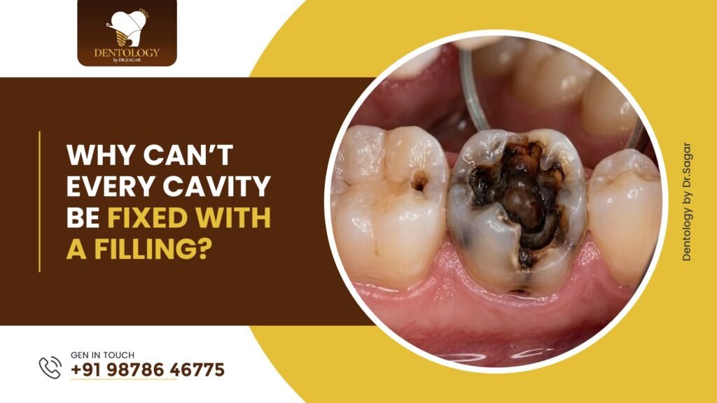 Why Can’t Every Cavity Be Fixed With a Filling?