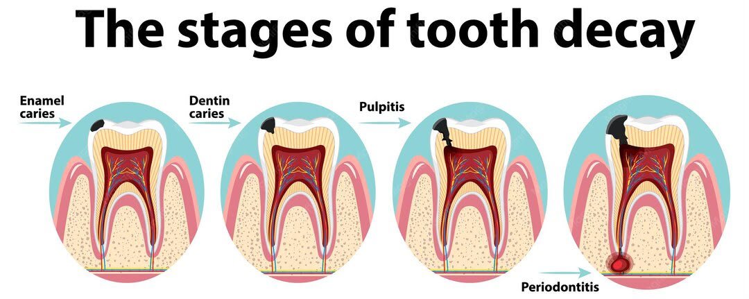 Why Can't Every Cavity Be Fixed With a Filling