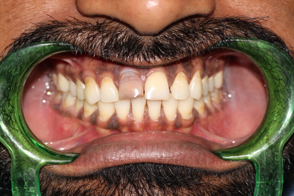 An Old Tooth Injury