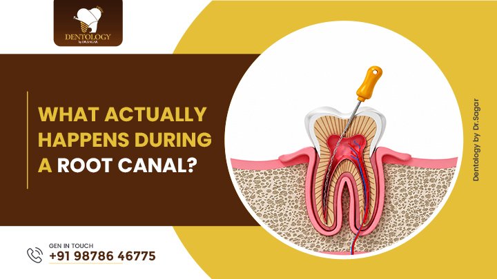 What Actually Happens During a Root Canal?