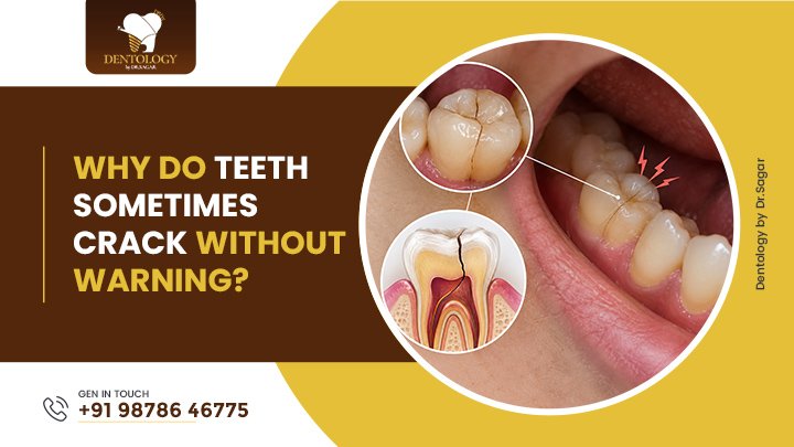 Why Do Teeth Sometimes Crack Without Warning?