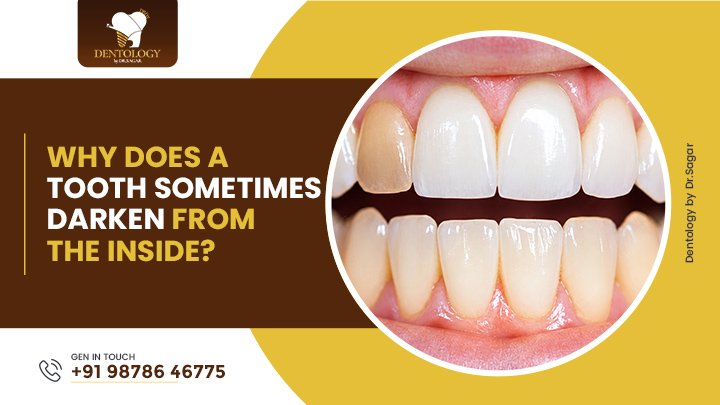 Why Does a Tooth Sometimes Darken From the Inside?